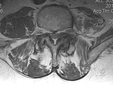 Lumbar MRI Stenosis Trefoil Canal